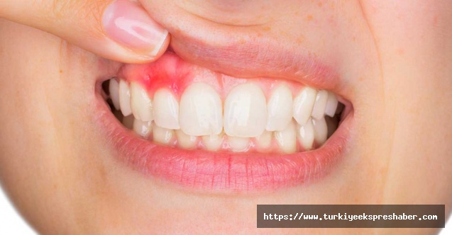 Dt.Özkaya'' korona diş ve diş eti problemlerini arttırdı''