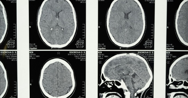 Araştırma: Uykunun REM evresine geçişte zorlanmak Alzheimer belirtisi olabilir