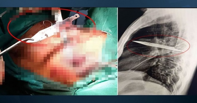 Ağrıyla gitti: 8 yıldır göğsünde bıçakla yaşadığını öğrendi