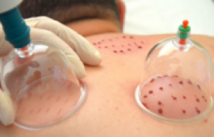 Eğer nezleyseniz çare ‘Hacamat’