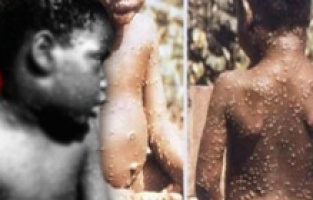 Koronadan kurtulamadan yeni bir ölümcül virüs başladı