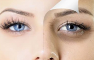 Göz altı morlukları nasıl geçer ve ne iyi gelir?