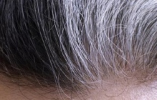 Beyazlayan saçların eski rengine dönmesi mümkün mü?