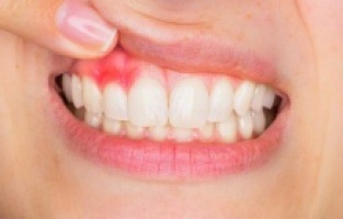 Dt.Özkaya'' korona diş ve diş eti problemlerini arttırdı''