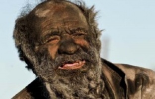 67 yıldır banyo yapmayan adamı muayene eden doktorlar şokta