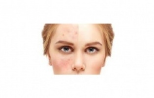 Cilt Lekeleri İçin Güzellik Sırları