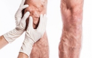 Varis Nedir? Neden Oluşur?