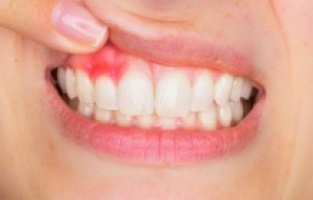 Vücuda yayılan diş enfeksiyonunun 5 yaygın belirtisi