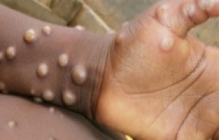 İstanbul'da maymun çiçeği paniği!