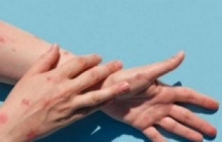 Türkiye'de 5 maymun çiçeği vakası tespit edildi