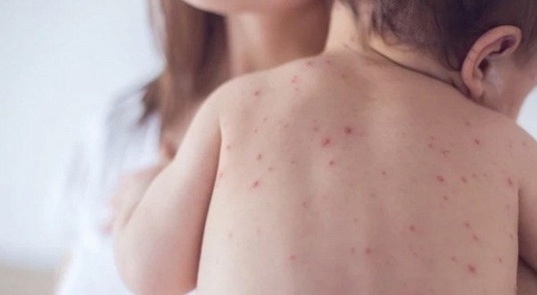 Bu belirtilere dikkat: Okullarda suçiçeği alarmı