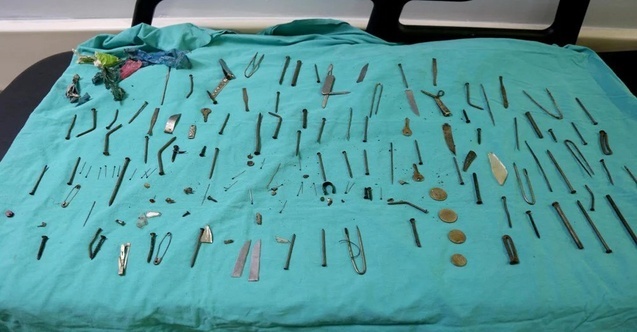 Midesinden 158 yabancı cisim çıkarıldı
