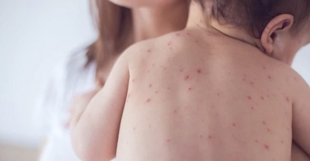 Bu belirtilere dikkat: Okullarda suçiçeği alarmı